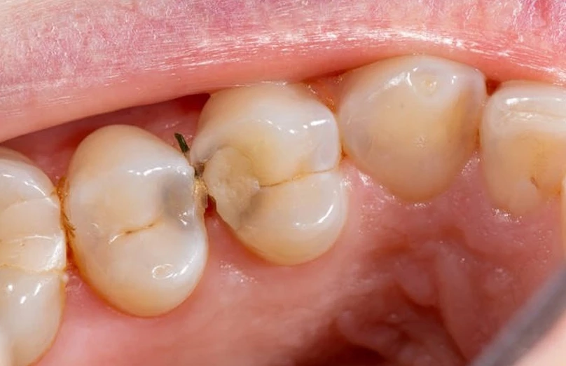 Vista clínica de caries interproximal avanzada