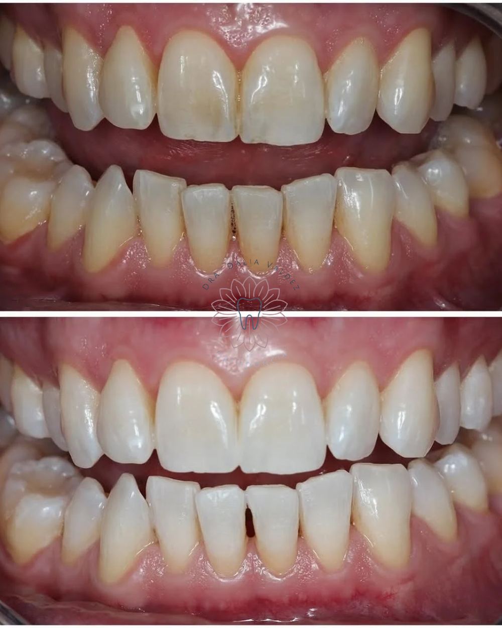 Antes y después de blanqueamiento dental profesional (imagen ilustrativa)